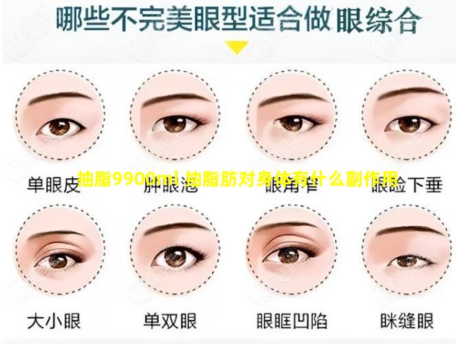 抽脂9900ml 抽脂肪对身体有什么副作用